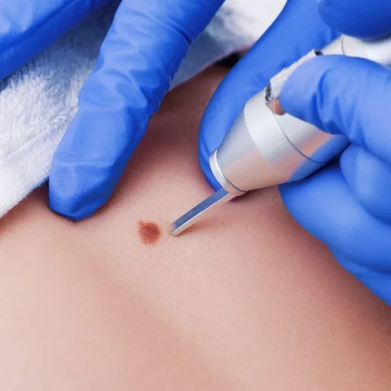 skin-tag-treatment